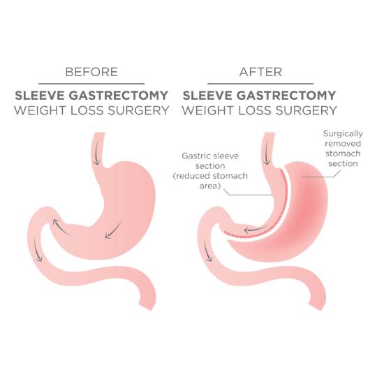 https://essemedicare.de/wp-content/uploads/2023/02/gastric_sleeve_1.jpg