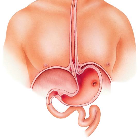 https://essemedicare.de/wp-content/uploads/2023/02/gastric_sleeve_2.jpg